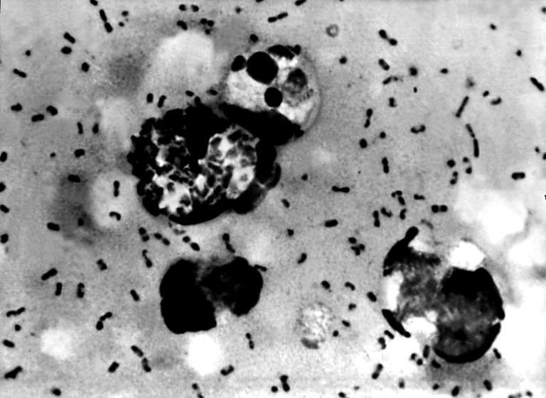 Bubonic plague smear demonstrating the presence of yersinia pest